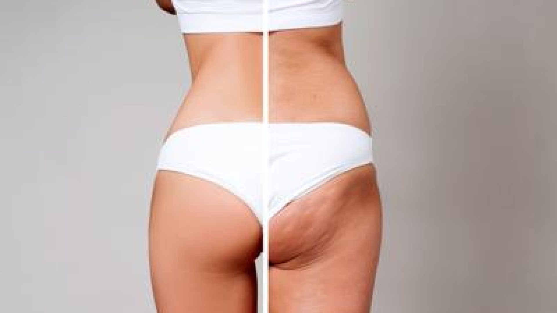 combattere-eliminare-cellulite